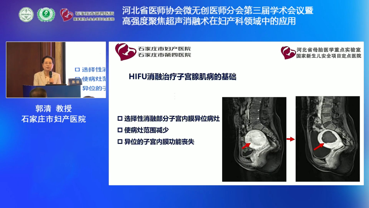 石家庄市第四医院郭清教授:高强度聚焦超声消融技术在本院的临床应用与发展