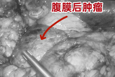 警惕这个沉默的「老六」！藏在体内却没有感觉……