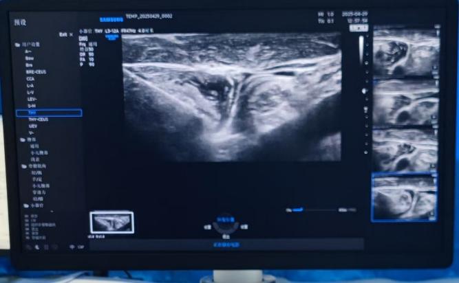 武汉大学人民医院多学科联合开展「冷循环微波消融」造福甲状腺结节患者