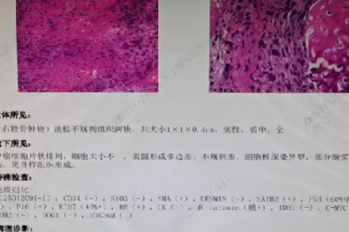 【高尚病例】右股骨骨肉瘤