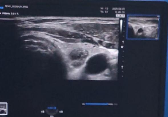 武汉大学人民医院多学科联合开展「冷循环微波消融」造福甲状腺结节患者