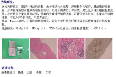 慢乙肝的他，每天 3 罐啤酒，如今肝纤维化，还能治愈吗？