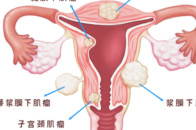 为什么同样是肌瘤，有人效果好有人差？个体差异的真相​
