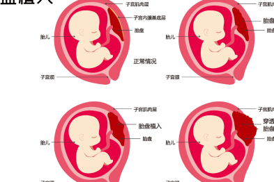 二胎妈妈最怕的情况！胎盘植入该怎么办？