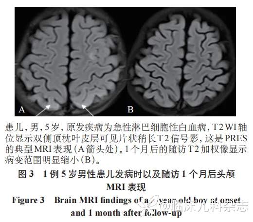 不同病因儿童高血压脑病临床特征比较：一项单中心 12 年回顾性分析