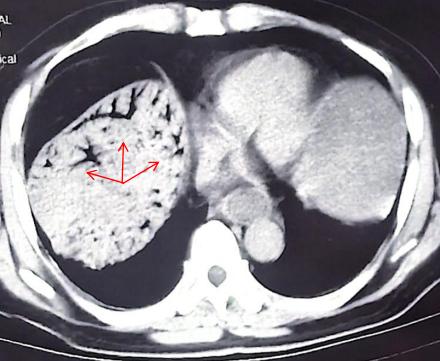 武汉大学人民医院多学科联手成功救治肝门静脉积气患者