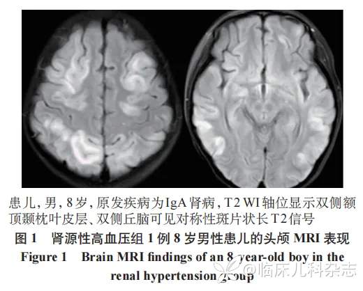 不同病因儿童高血压脑病临床特征比较：一项单中心 12 年回顾性分析