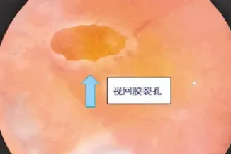 运动后视网膜竟破了个「洞」？这几类人群要注意了！