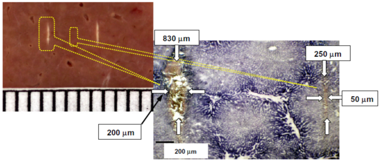 聚焦超声消融手术，无创时代的外科手术范式革命