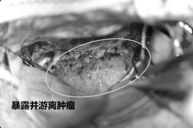 无影灯下的极限操作：看神外『「拆弹军团」如何征服颅底禁区