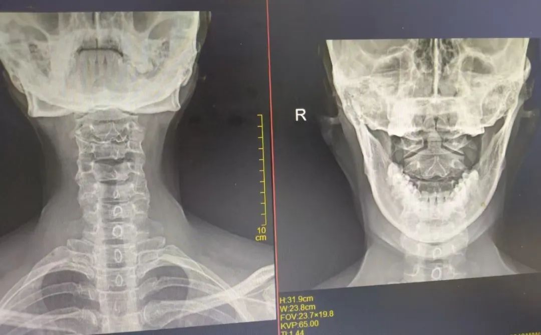 28 岁姑娘「干眼症」治疗无果？颈椎病竟是 「幕后黑手」！