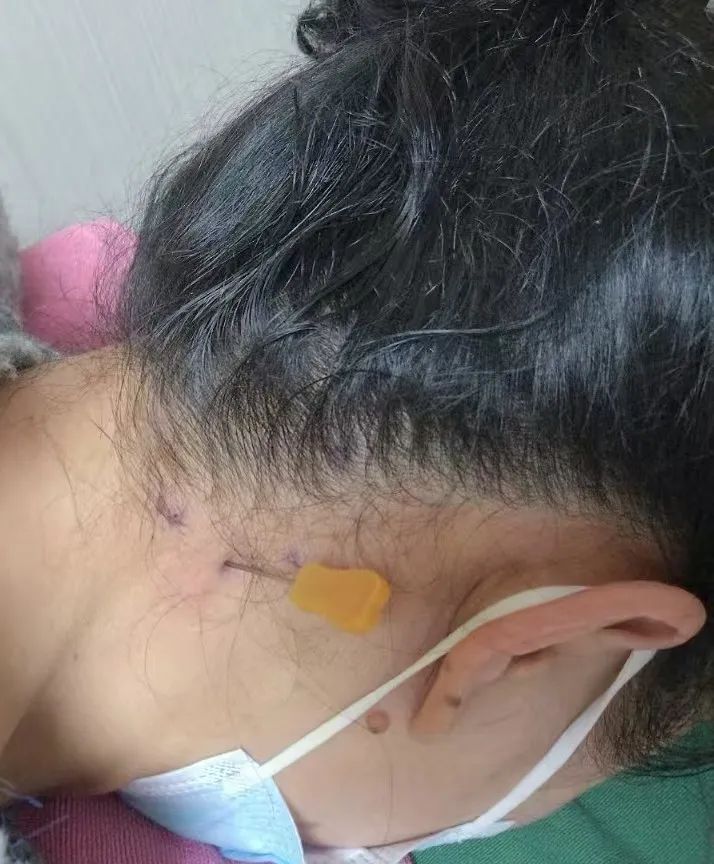 28 岁姑娘「干眼症」治疗无果？颈椎病竟是 「幕后黑手」！