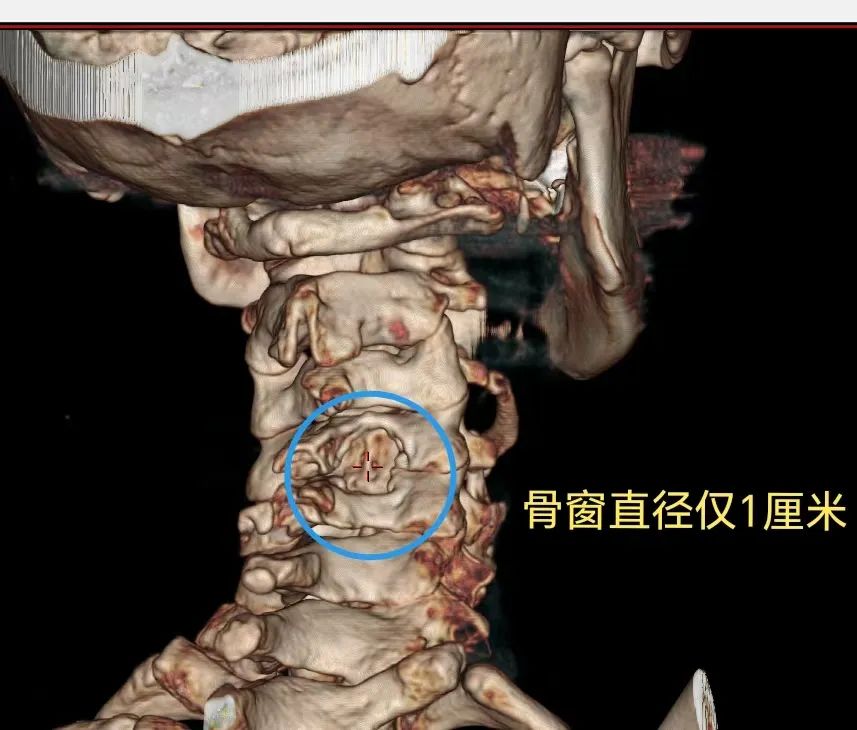 漳州三院神经外科施妙手：解除七旬老人右侧肩臂剧痛之苦