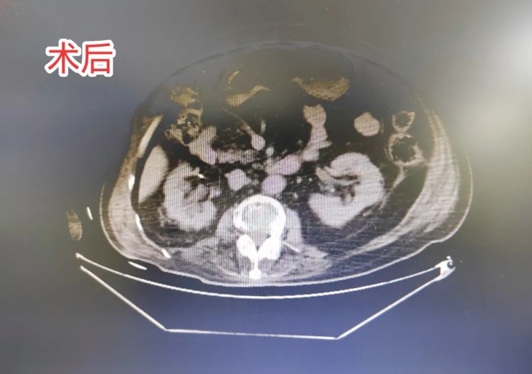 当截石位「失效」，漳州三院如何完成这场泌尿系结石手术