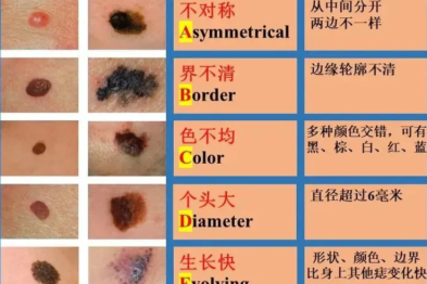 如何科学防治色素痣？警惕这些「危险信号」