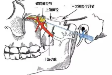 这种头痛让人痛不欲生，但有得治！