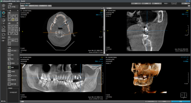 重庆松山医院口腔科为海南患者完成上颌窦复杂种植修复