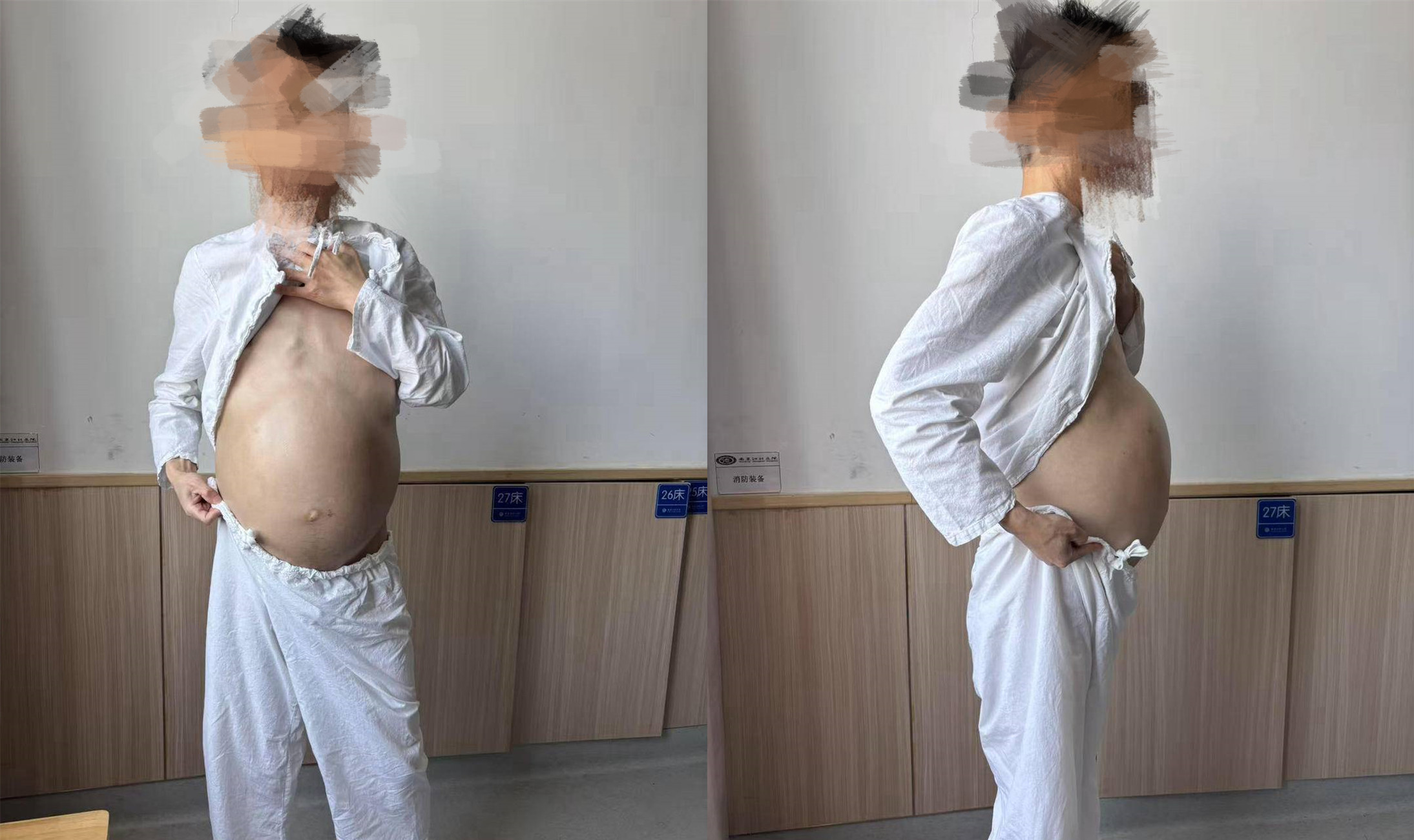 先天性巨结肠男子 4 个月未解大便,切除近三米长「巨蟒」病肠!