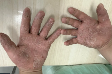 男孩手上水疱奇痒，奶奶用花椒水「祛湿」，娃手烂了