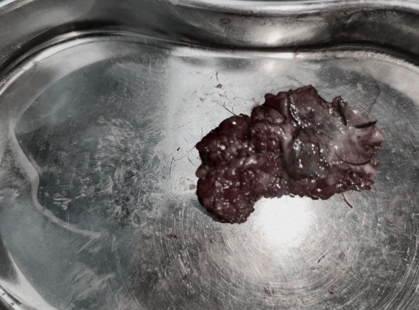 漳州 18 岁学生久坐后骶尾「闹危机」，肛肠科巧解「藏毛困局」