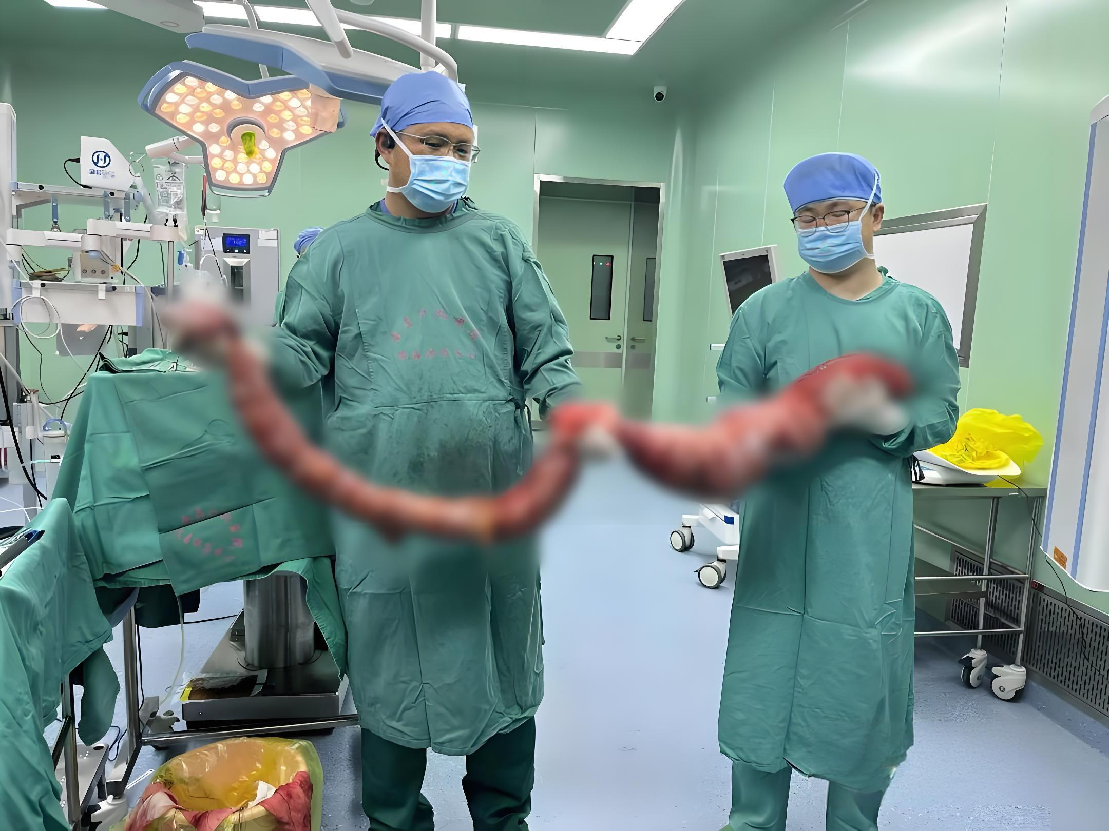 先天性巨结肠男子 4 个月未解大便,切除近三米长「巨蟒」病肠!