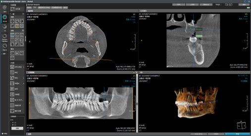 重庆松山医院口腔科为海南患者完成上颌窦复杂种植修复