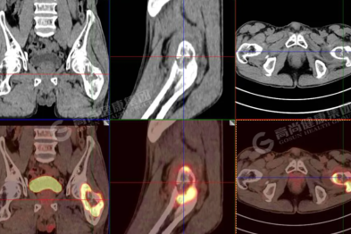 【高尚病例】软骨肉瘤 PET/CT 显像一例