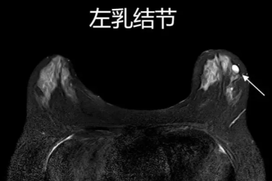 揭秘乳腺磁共振：你的 「看不见的守护者」