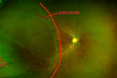 古天乐视网膜惊现两洞！飞蚊症背后竟是视力「定时炸弹」？