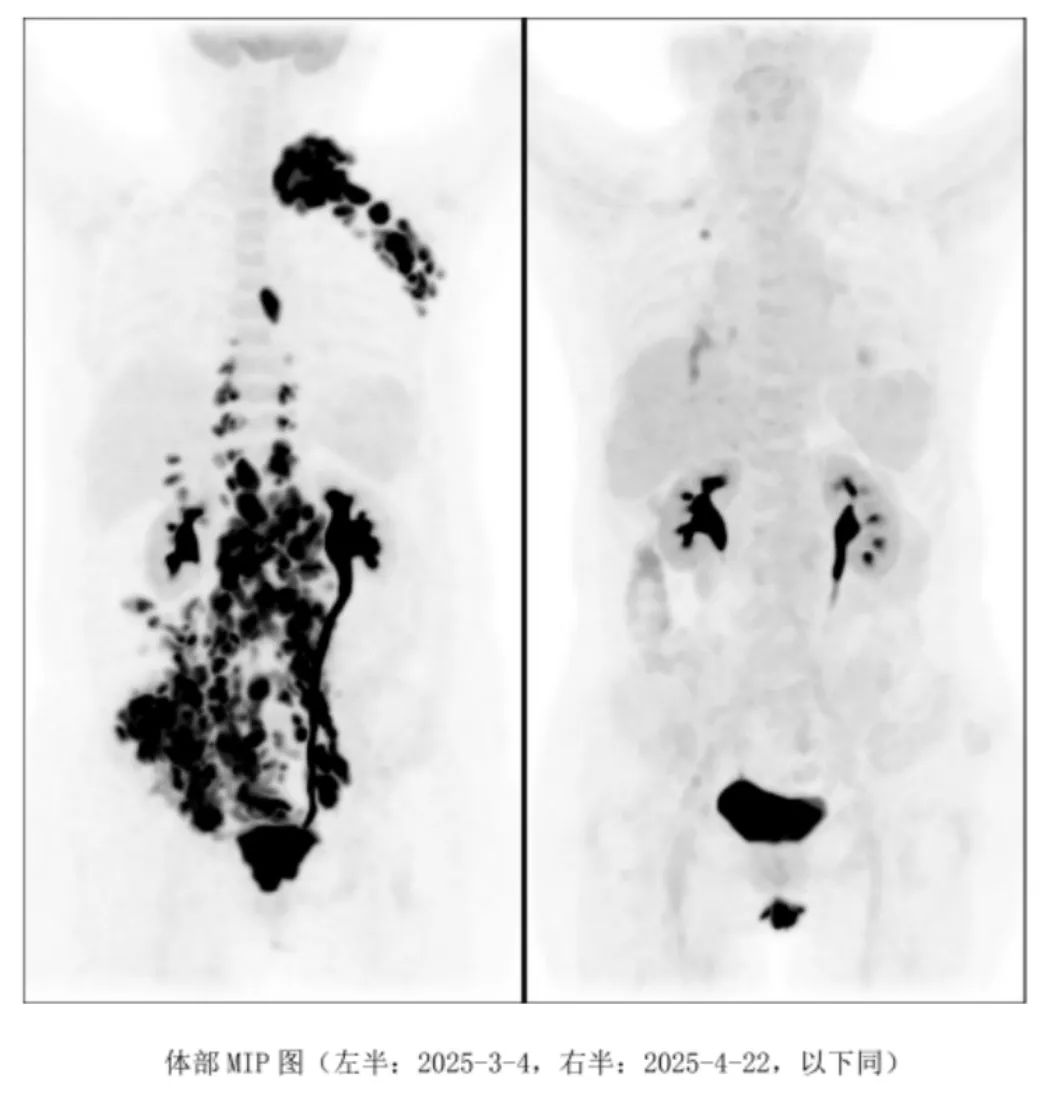 CAR-T 治疗成功逆转老年复发难治弥漫大 B 细胞淋巴瘤