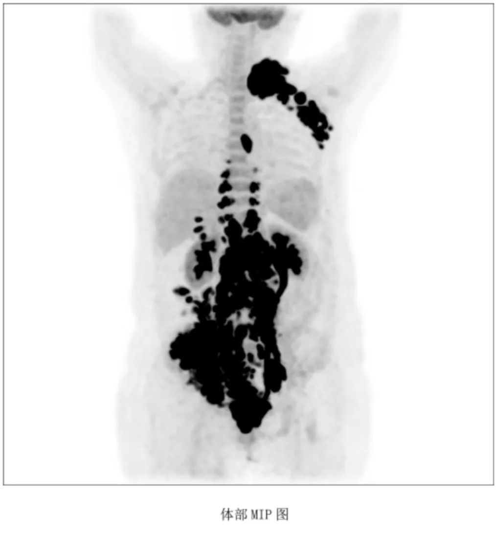 CAR-T 治疗成功逆转老年复发难治弥漫大 B 细胞淋巴瘤
