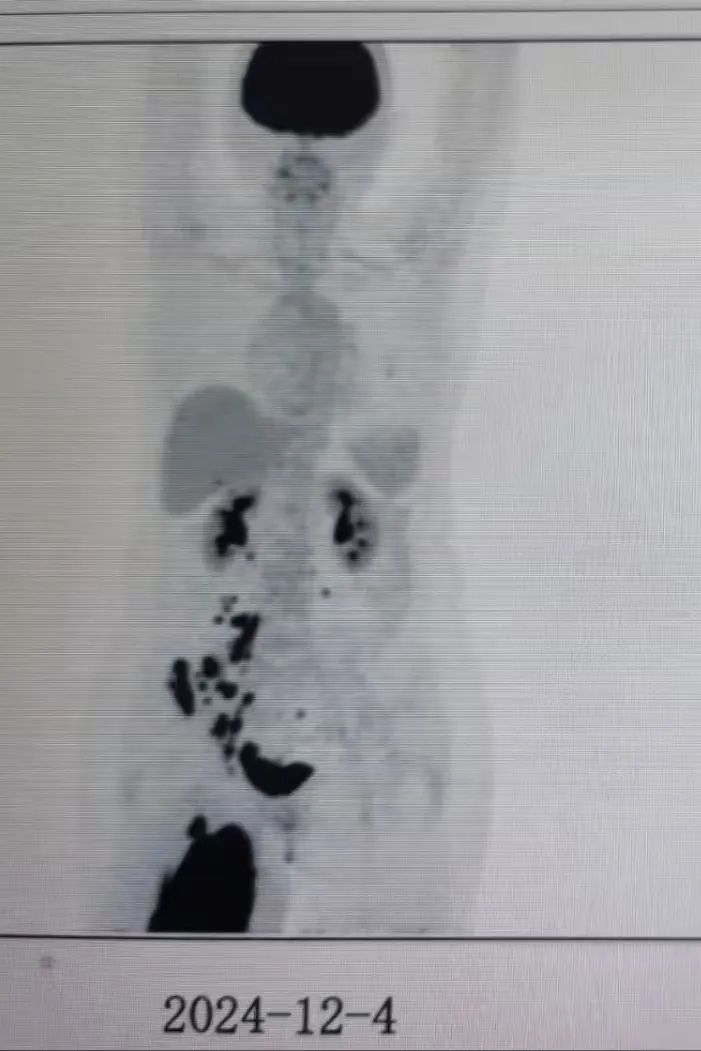 CAR-T 治疗成功逆转老年复发难治弥漫大 B 细胞淋巴瘤