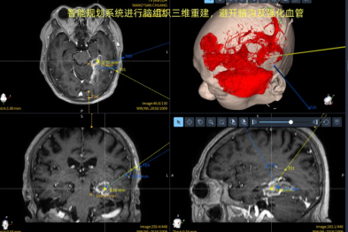 79 岁老人大脑深处病变！机器人「神助攻」，精准锁定病灶
