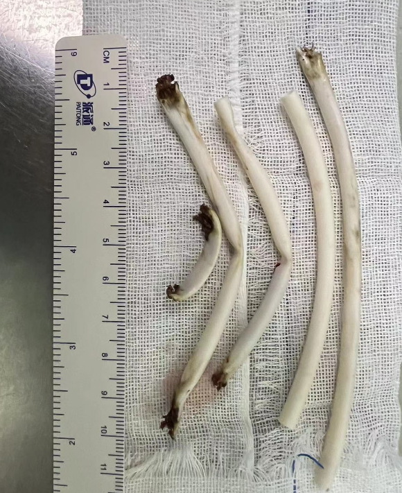 尿血 3 个月，医生从他膀胱取出 72 颗「彩虹糖」？！