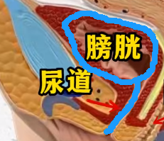 尿血 3 个月，医生从他膀胱取出 72 颗「彩虹糖」？！