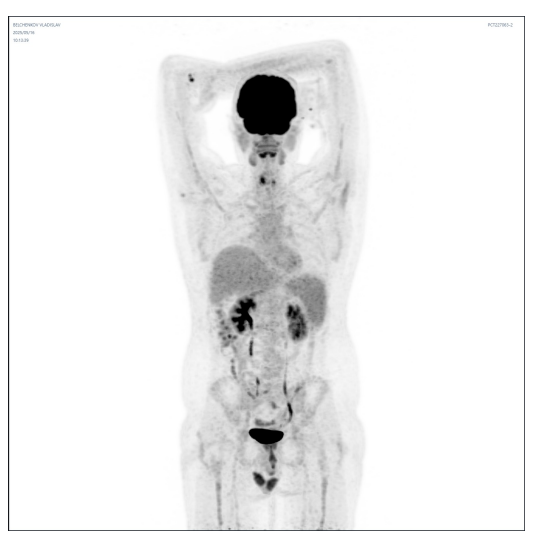 跨越国界的生命奇迹：CAR-T 助力俄罗斯青年逆转难治性弥漫大 B 细胞淋巴瘤困局