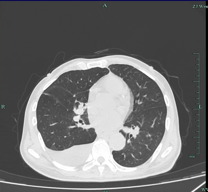 从「牛奶胸」到重生：一场淋巴管的精准狙击战