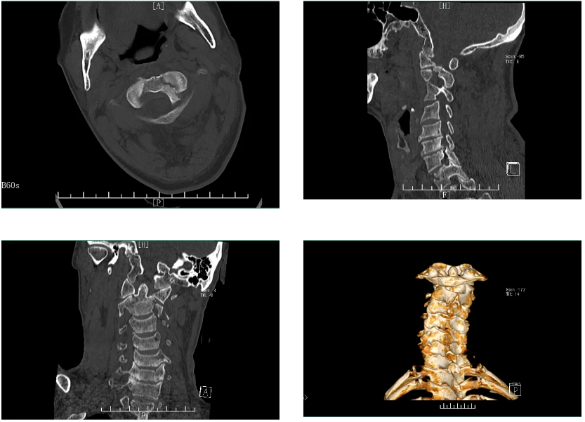 漳州正兴医院顺利开展上颈椎骨折脱位切开复位内固定术