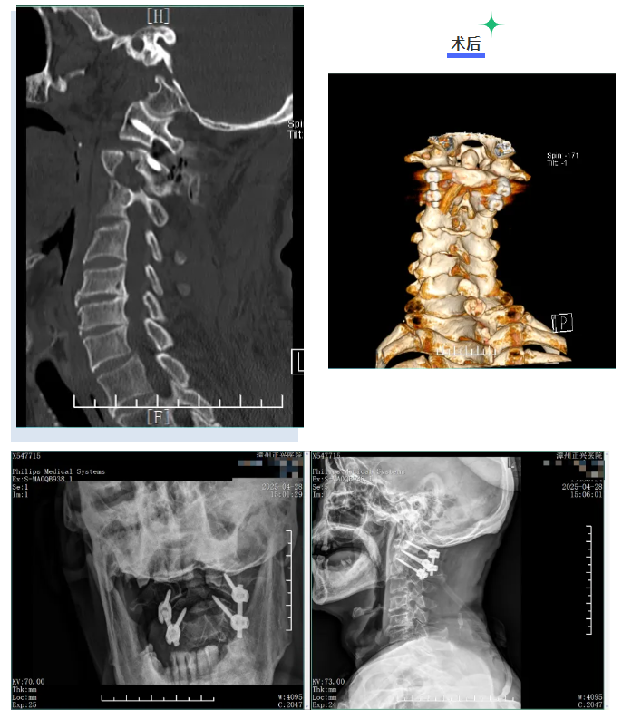 漳州正兴医院顺利开展上颈椎骨折脱位切开复位内固定术