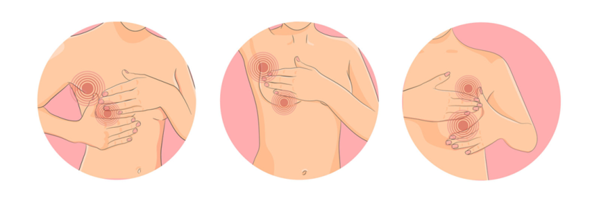 当心！女性的「头号癌」乳腺癌，4 个症状速速就医！