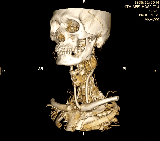 4 年没管的颈部小包，最后长成「夺命瘤」！医生：这些症状千万别拖