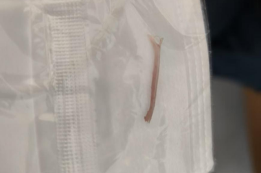 警惕胃异物穿孔——从一例鱼刺穿孔案例说起