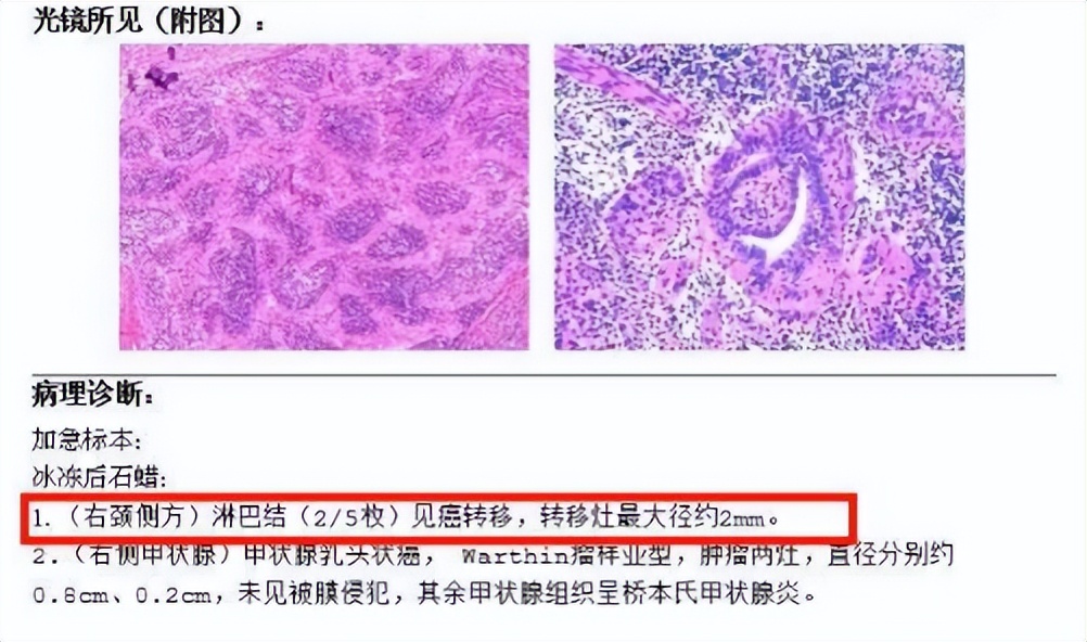 甲状腺微小结节「藏着」癌症大风险！武大人民医院乳甲外科领衔 MDT 团队精准歼灭甲状腺「微小癌」