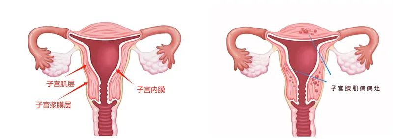 子宫腺肌病的分型