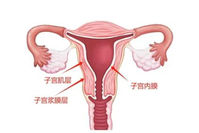子宫腺肌病的分型
