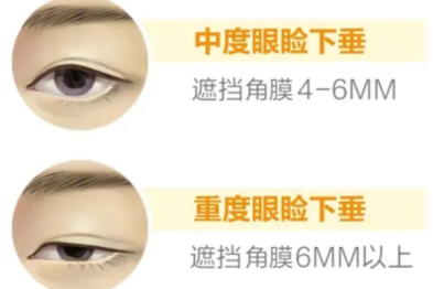 孩子眼睛睁不开，还以为是年龄小「没长开」？NO