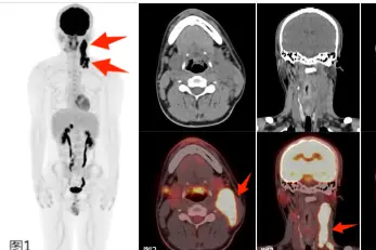不明原因的发热？PET/CT 精准「锁定」病灶