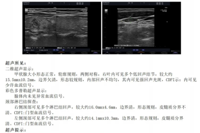 【高尚病例】体检发现甲状腺癌（伴颈侧区淋巴结转移）