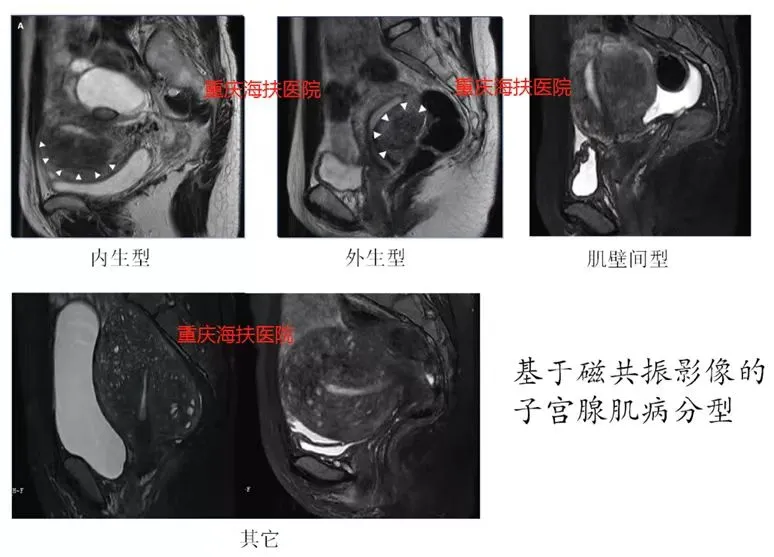子宫腺肌病的分型