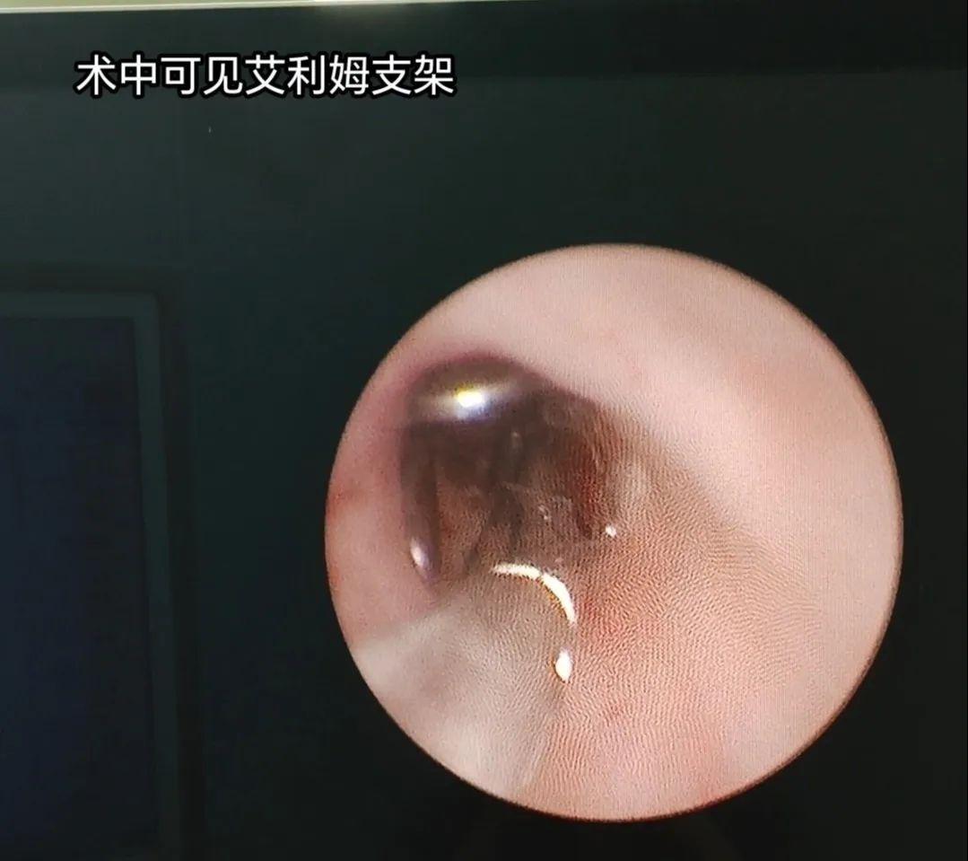 输尿管狭窄反复困扰？艾利姆支架「一招制敌」